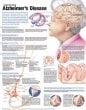 Understanding Alzheimer's Disease Anatomical Chart. Edition Second