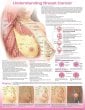 Understanding Breast Cancer Anatomical Chart. Edition Fourth