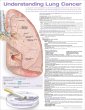Understanding Lung Cancer Anatomical Chart. Edition Second