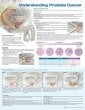 Understanding Prostate Cancer Anatomical Chart. Edition Third