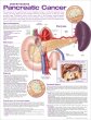Understanding Pancreatic Cancer Anatomical Chart. Edition Second