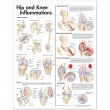 Hip and Knee Inflammations Anatomical Chart . Edition Second