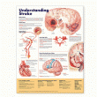 Understanding Stroke Anatomical Chart. Edition Second