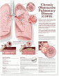 Chronic Obstructive Pulmonary Disease Anatomical Chart . Edition Second