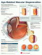 Age-Related Macular Degeneration Anatomical Chart. Edition First