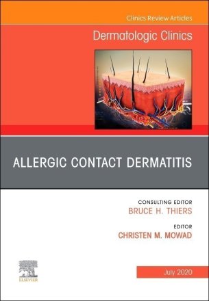 Allergic Contact Dermatitis,An Issue of Dermatologic Clinics