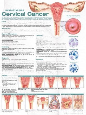 Understanding Cervical Cancer Anatomical Chart. Edition Second