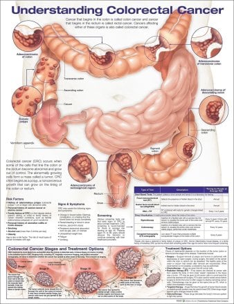 Understanding Colorectal  Cancer Anatomical Chart. Edition Second