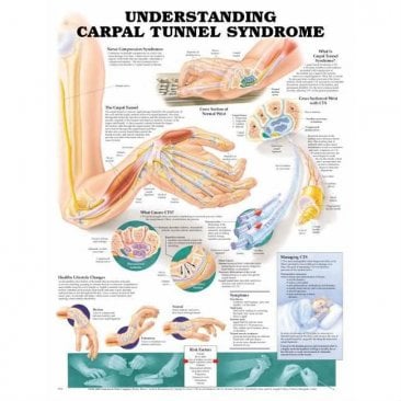 Understanding Carpal Tunnel Syndrome Chart (Flexible Laminated Poster) ISBN 9781587793219