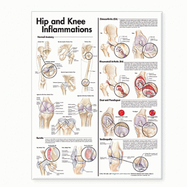 Hip and Knee Inflammations Anatomical Chart, 2nd Edition