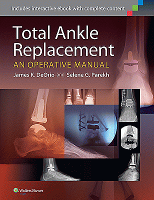 Total Ankle Replacement:  An Operative Manual. Edition First