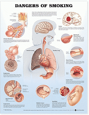 Dangers of Smoking Anatomical Chart