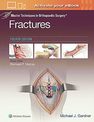 Master Techniques in Orthopaedic Surgery: Fractures. Edition Fourth