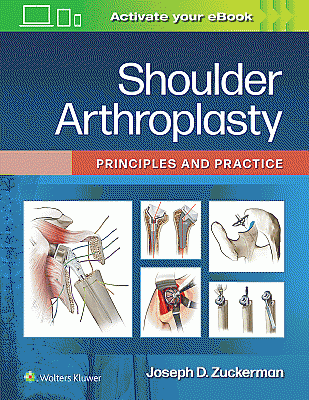 Shoulder Arthroplasty. Edition First