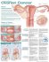 Understanding Ovarian Cancer Anatomical Chart. Edition Second