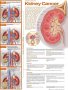 Understanding Kidney Cancer Anatomical Chart. Edition Second