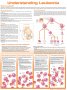 Understanding Leukemia Anatomical Chart. Edition Second