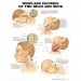 Whiplash Injuries of the Head and Neck (Flex Laminated Poster) ISBN 9781587793752