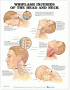 Whiplash Injuries of the Head and Neck Anatomical Chart